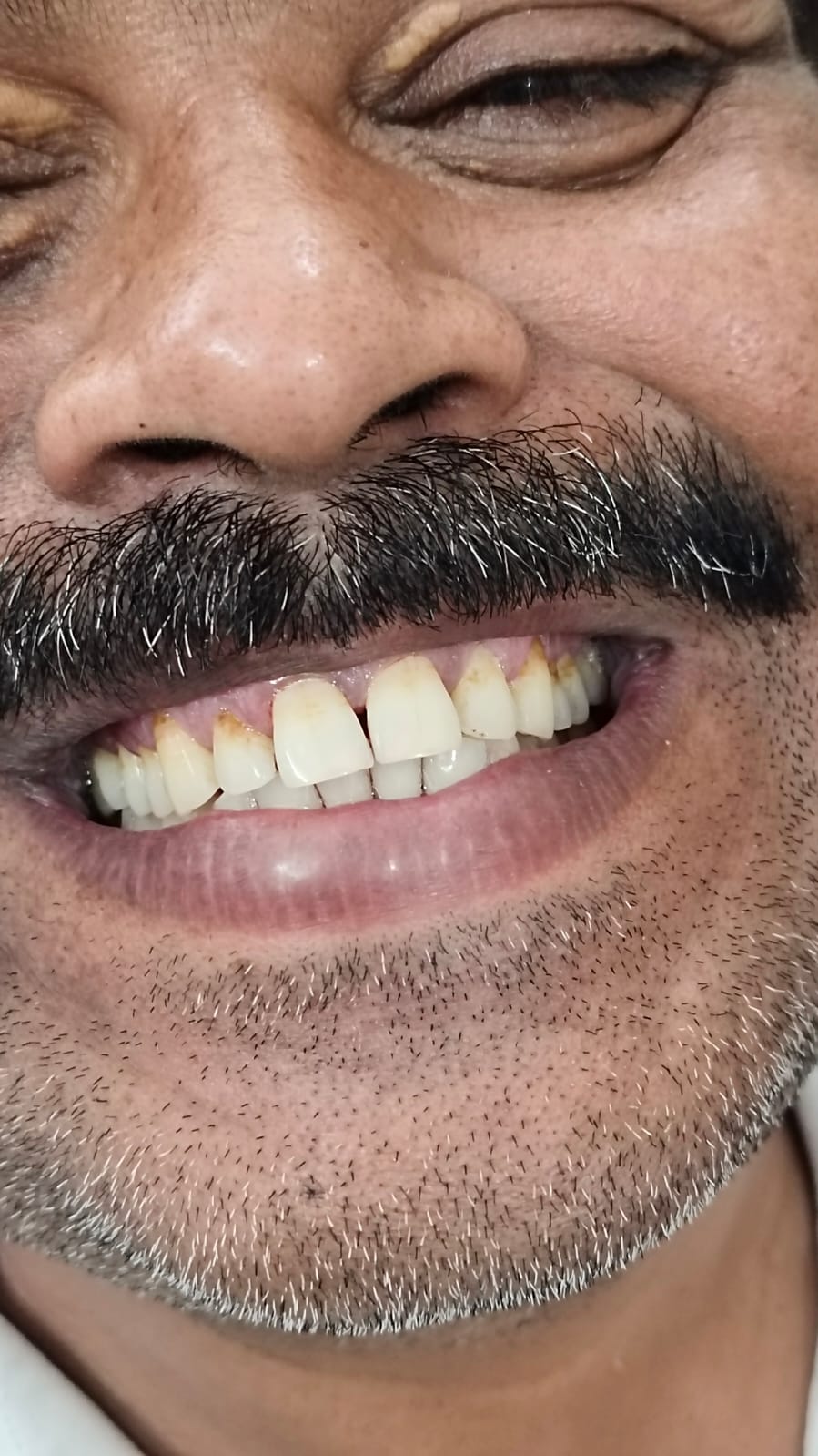 Patient 1 case photo after care