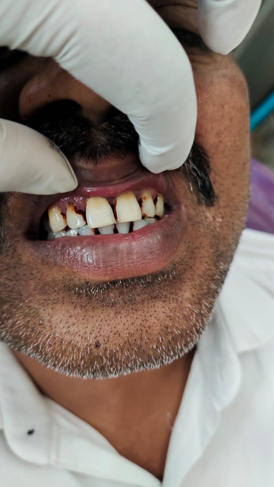 Patient 1 case photo before care