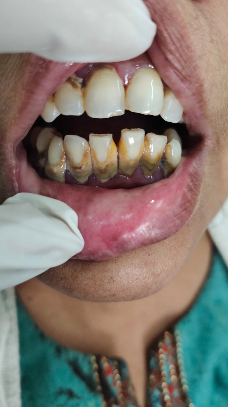 Patient 3 case photo before care